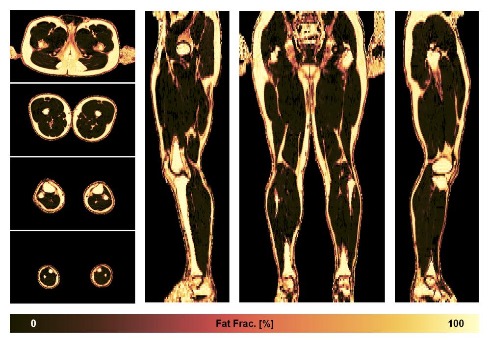 The fat fraction of the lower extremity obtained from the dixon reconstruction for muscle water fat quantification.